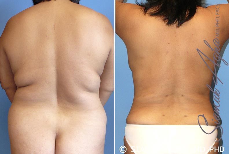 Liposuction Before & After