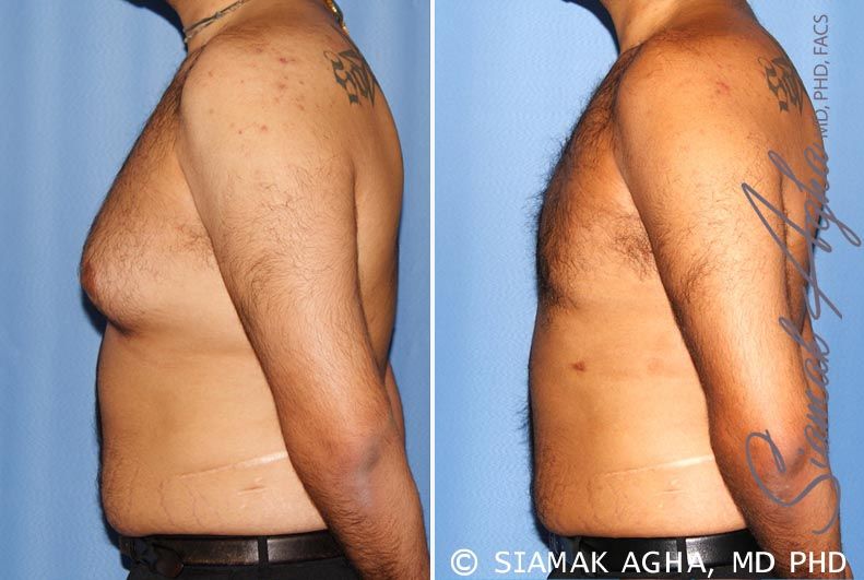 Liposuction Before & After