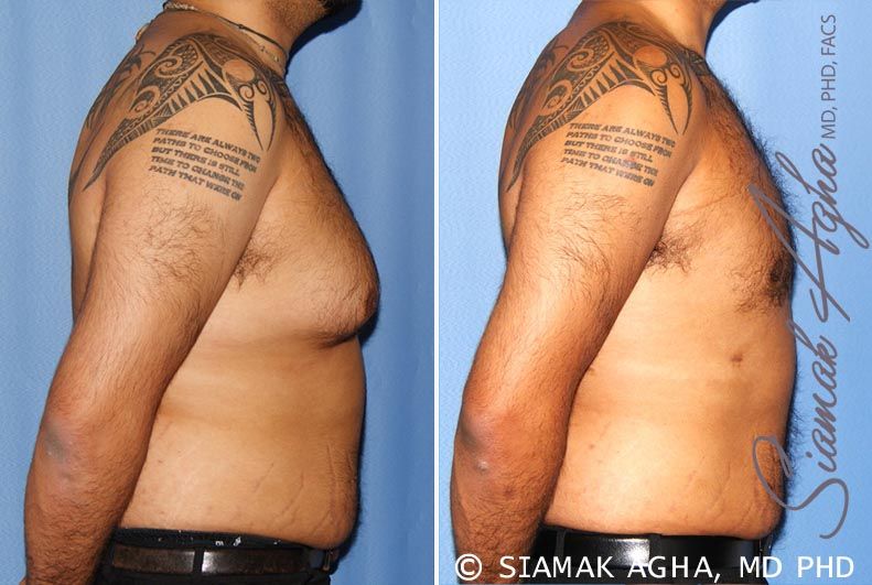 Liposuction Before & After