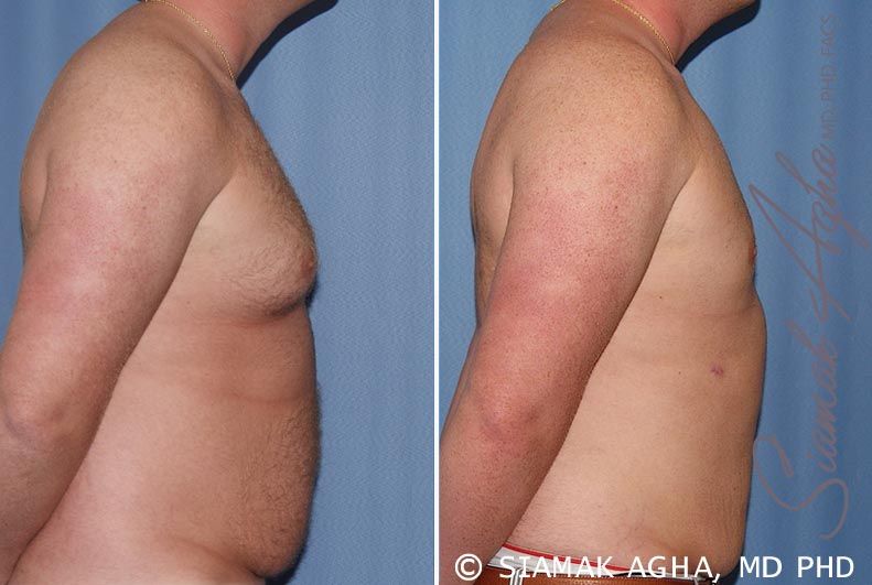 Liposuction Before & After