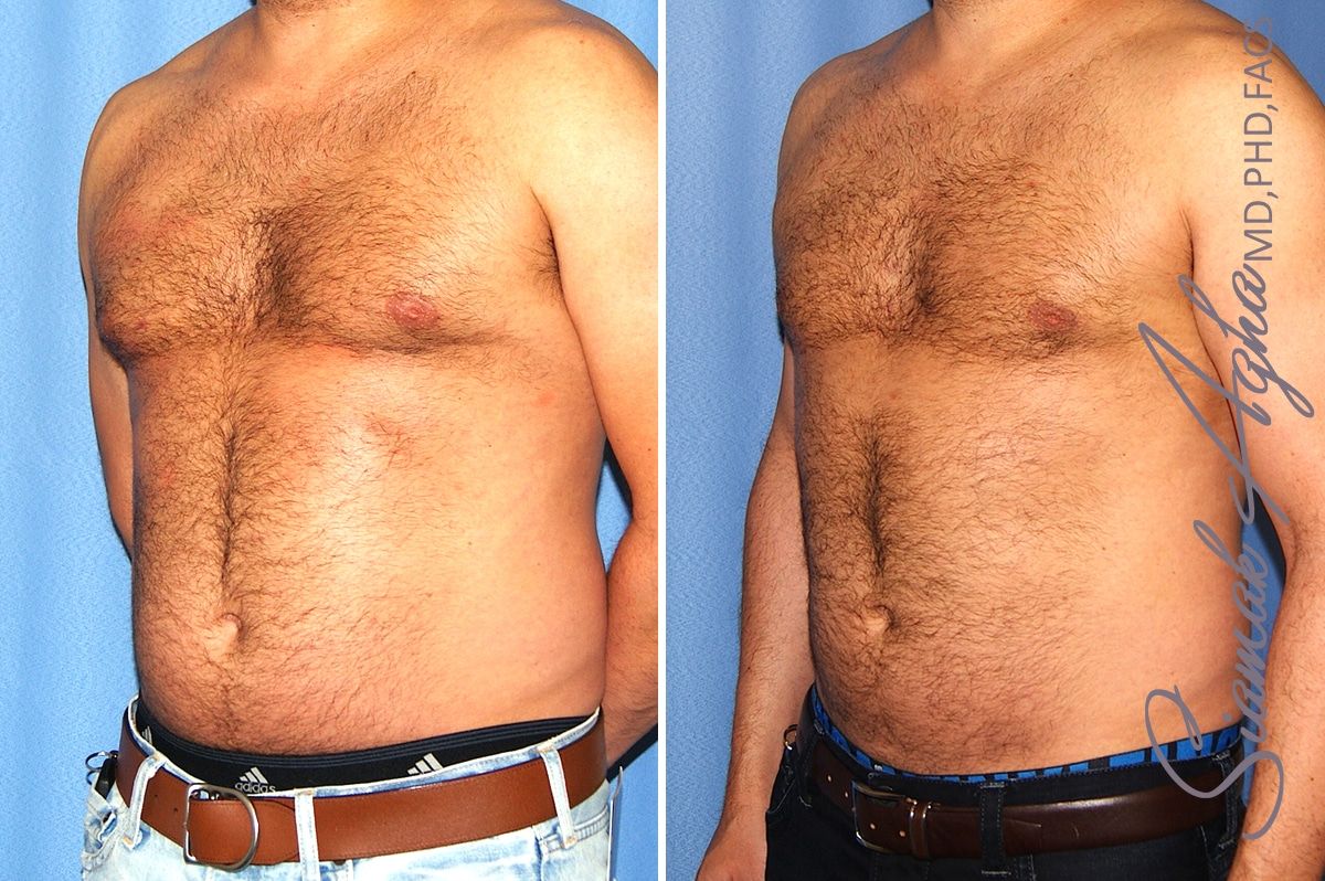 Liposuction Before & After