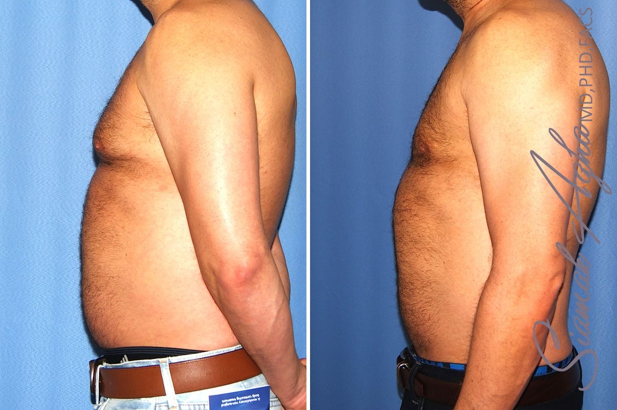Liposuction Before & After