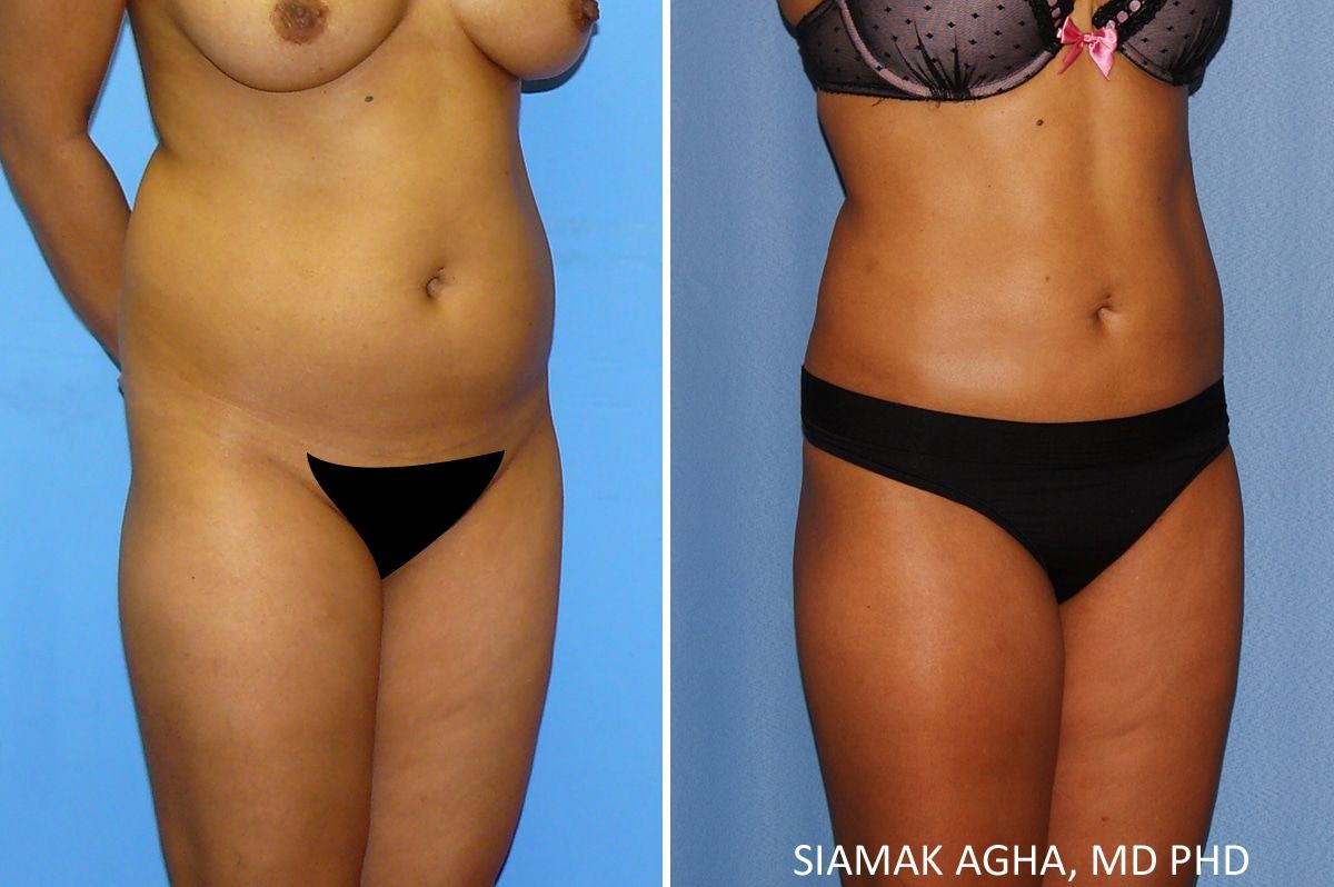 Liposuction Before & After