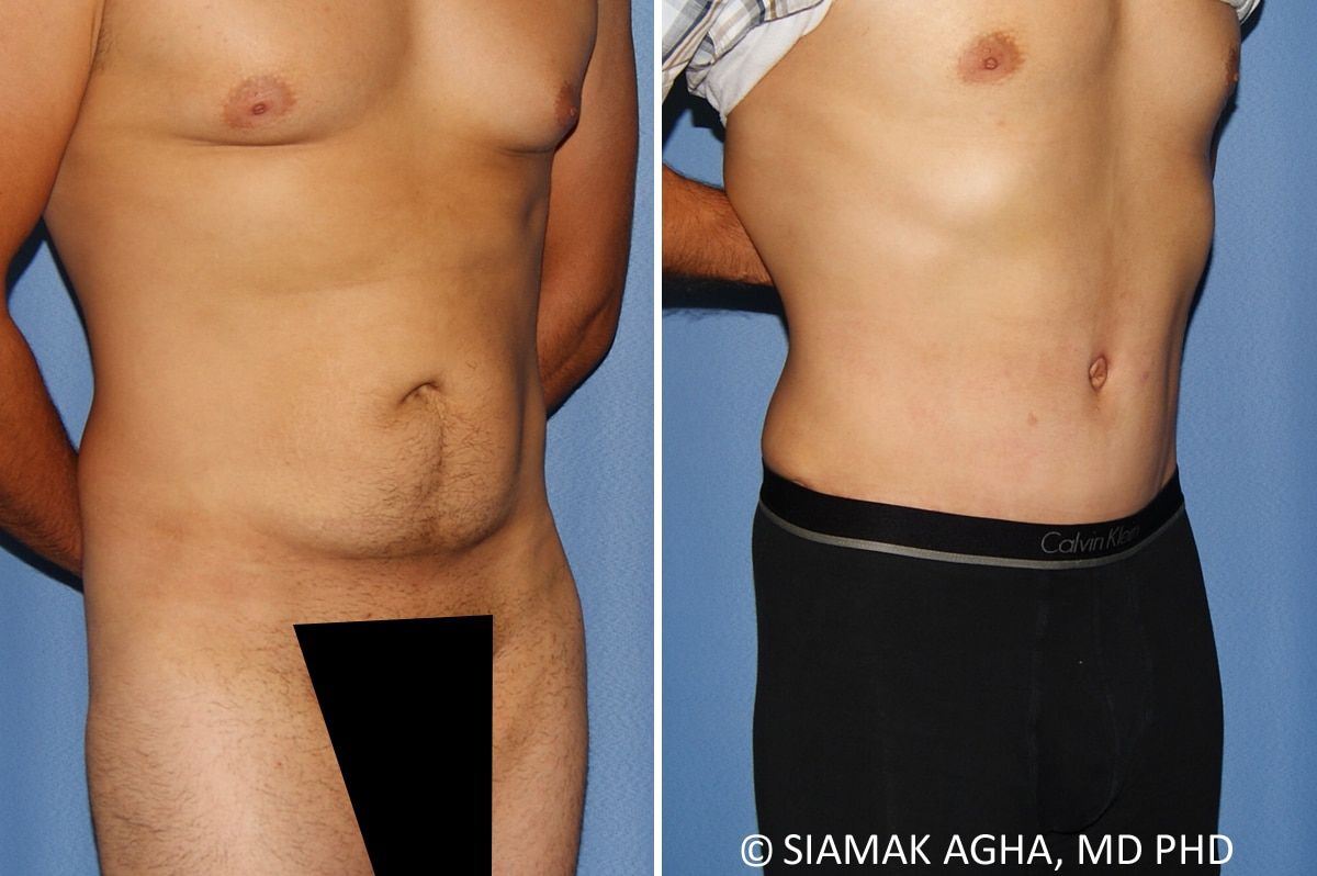 Liposuction Before & After