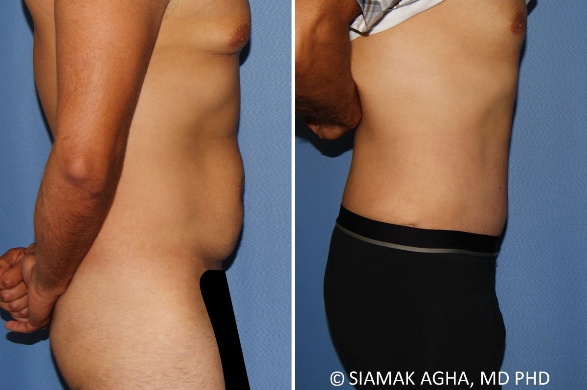 Liposuction Before & After
