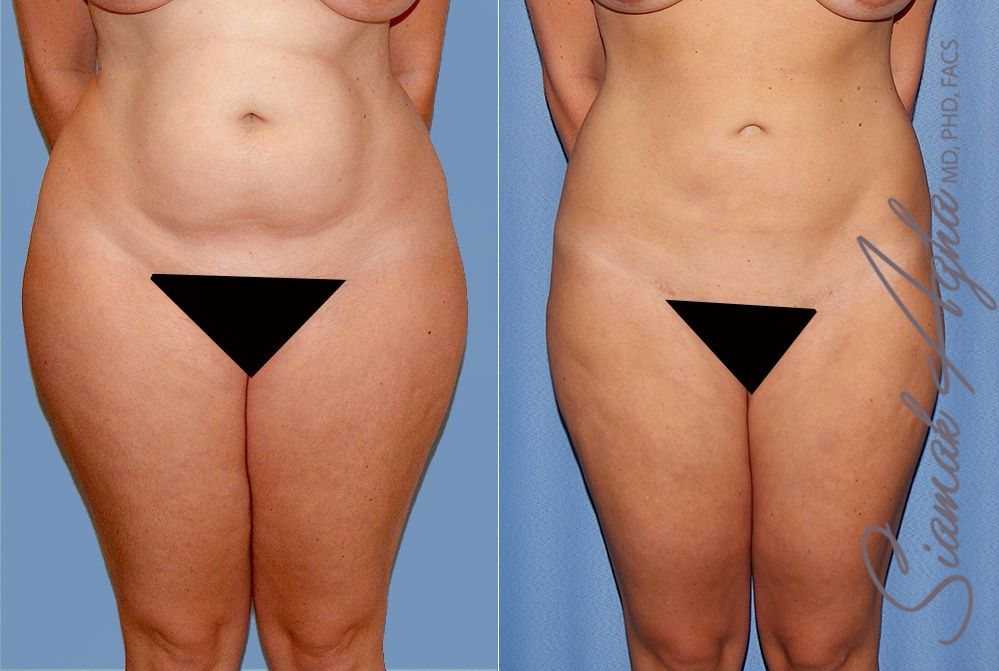 Liposuction Before & After