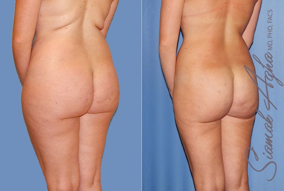 Liposuction Before & After
