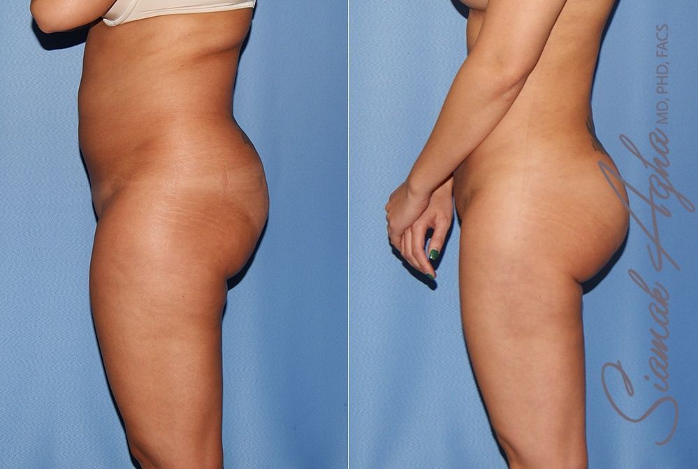 Liposuction Before & After