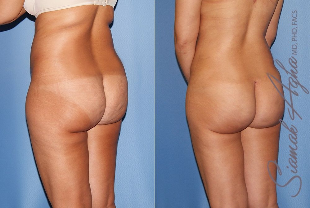 Liposuction Before & After