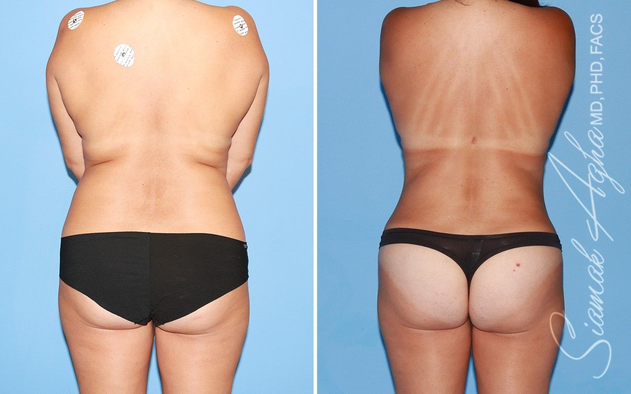 Liposuction Before & After