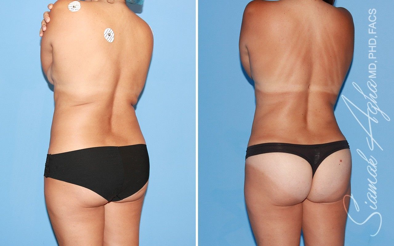 Liposuction Before & After
