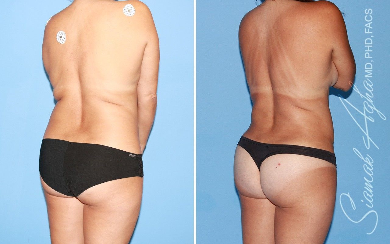 Liposuction Before & After