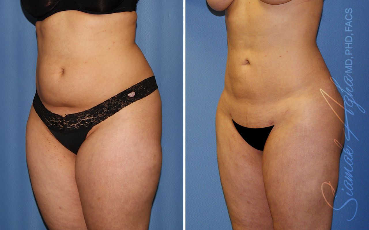 Liposuction Before & After