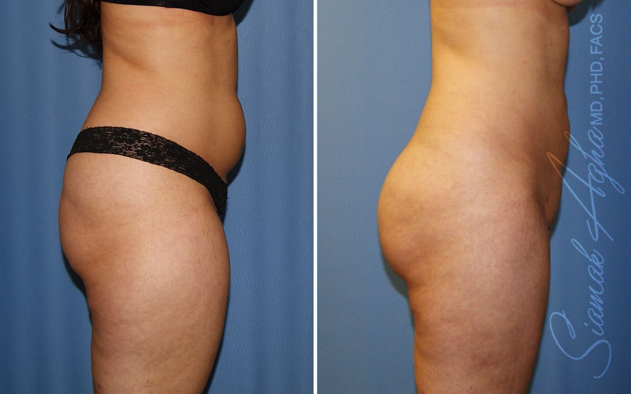 Liposuction Before & After