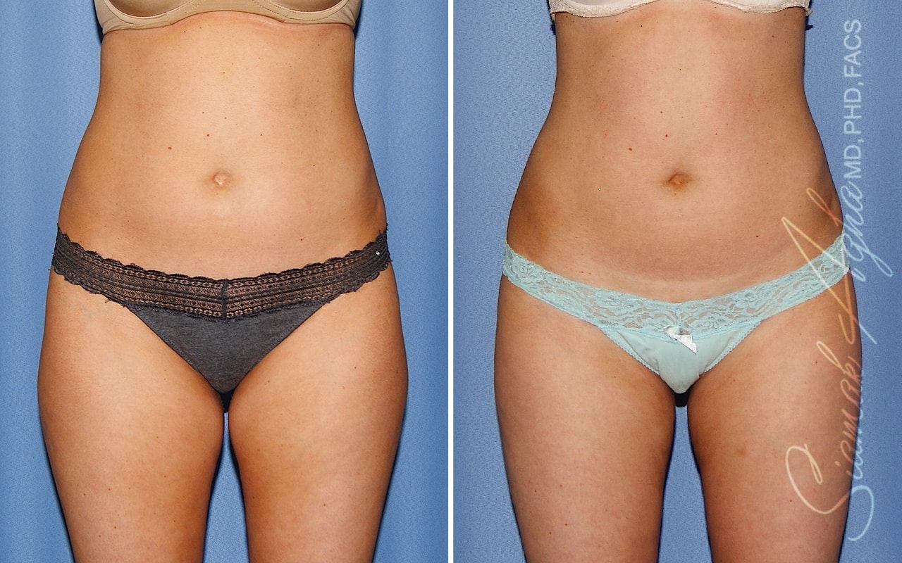 Liposuction Before & After