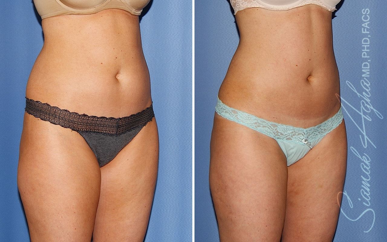 Liposuction Before & After