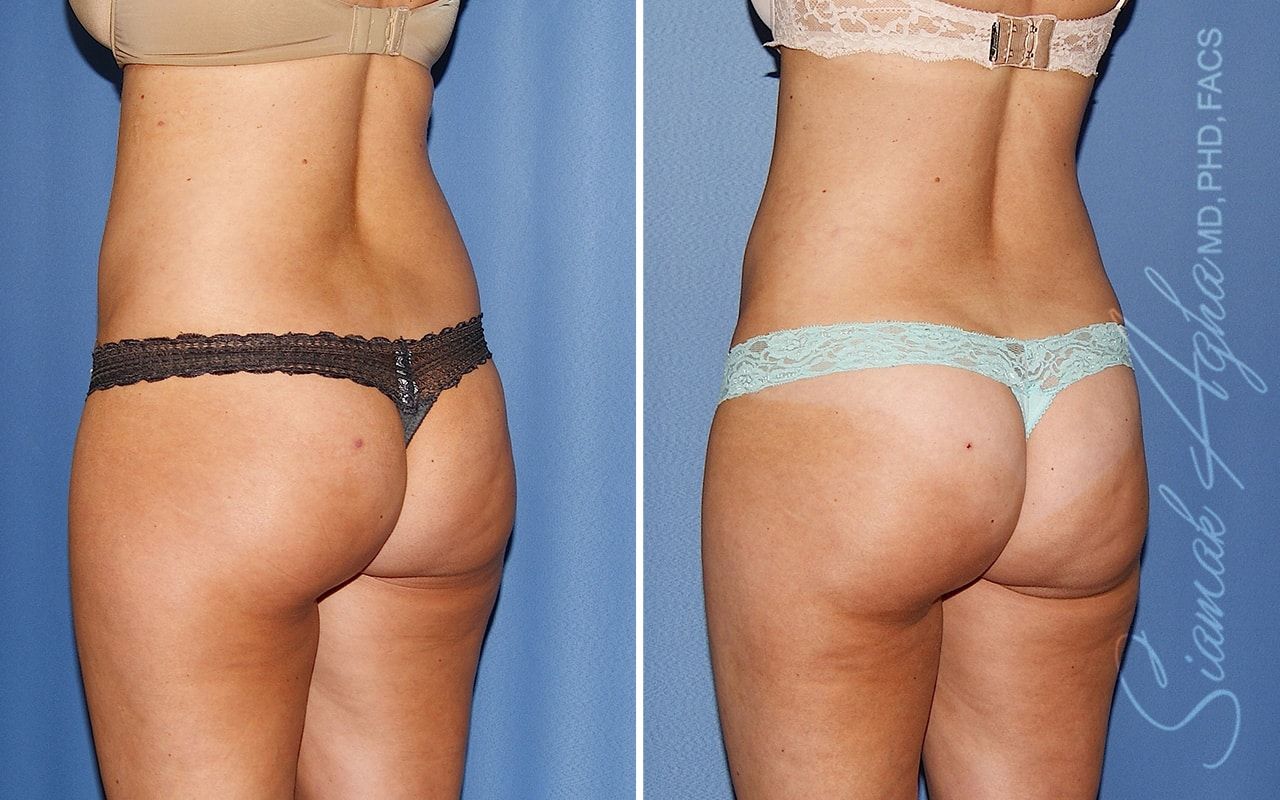 Liposuction Before & After