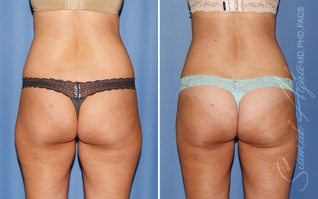 Liposuction Before & After