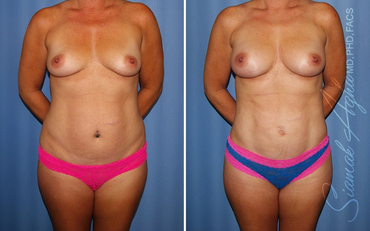Liposuction Before & After