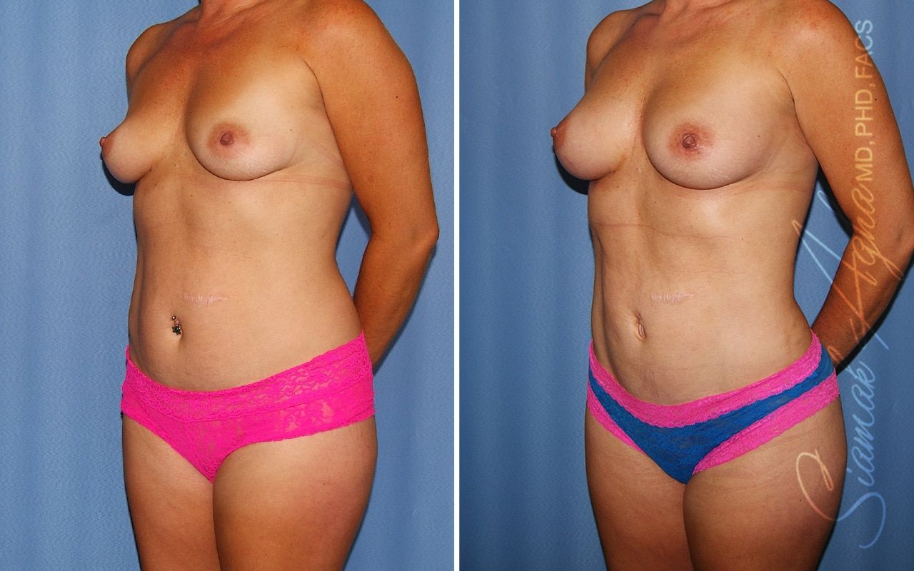 Liposuction Before & After