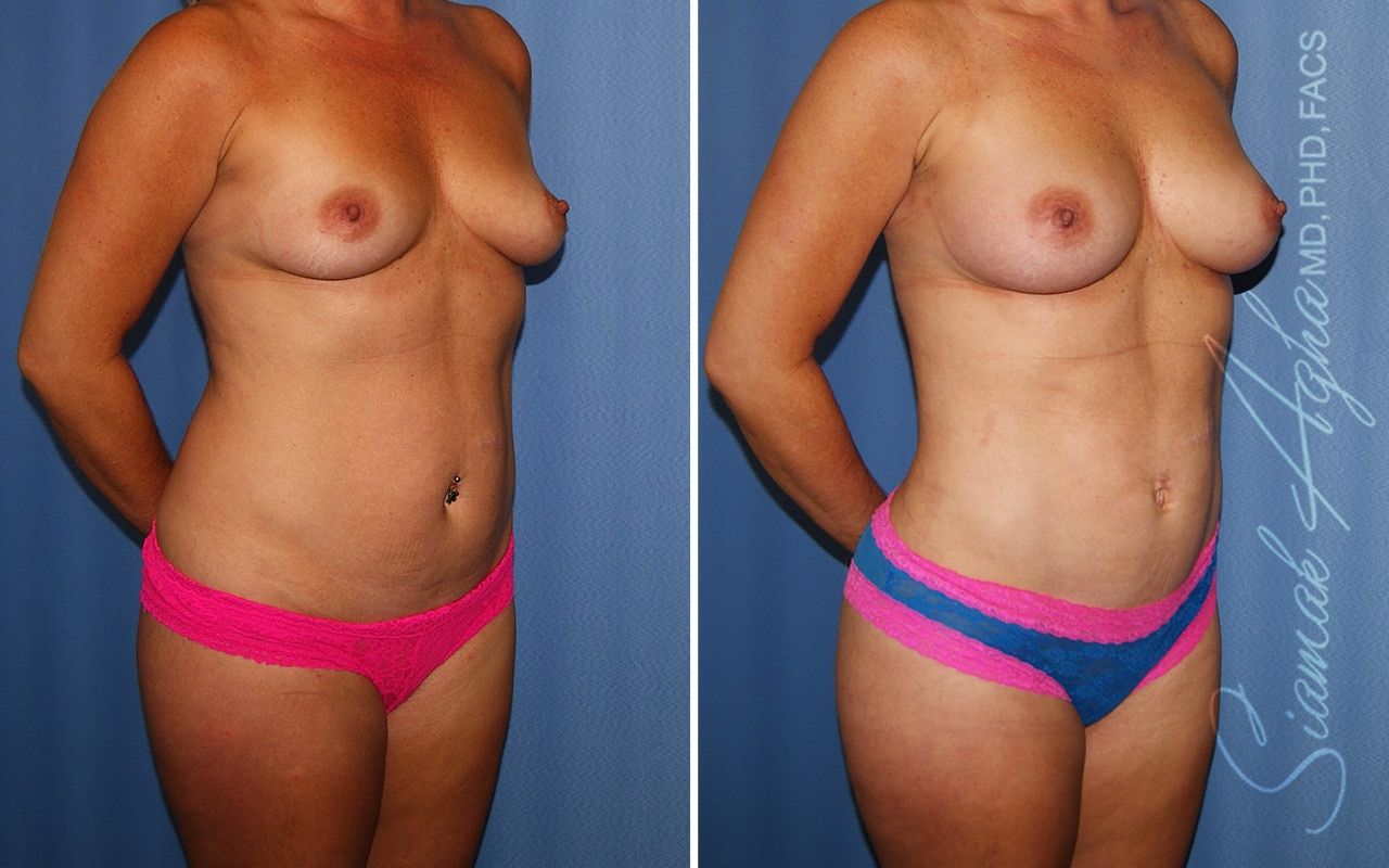 Liposuction Before & After