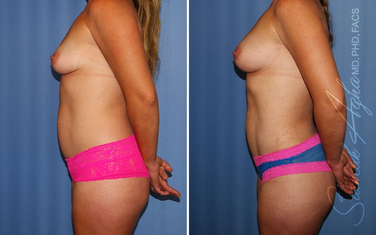 Liposuction Before & After