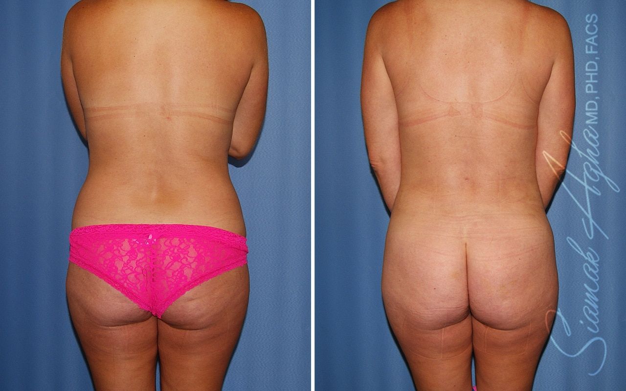 Liposuction Before & After