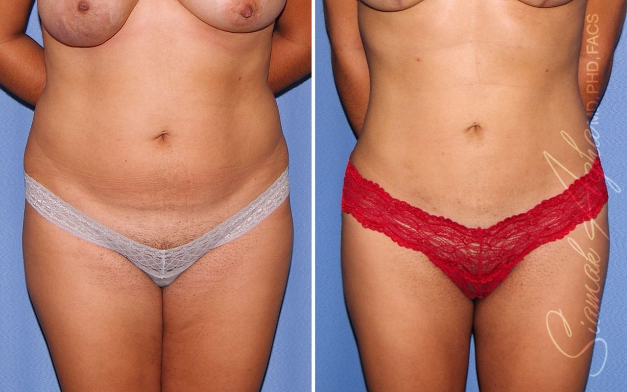 Liposuction Before & After