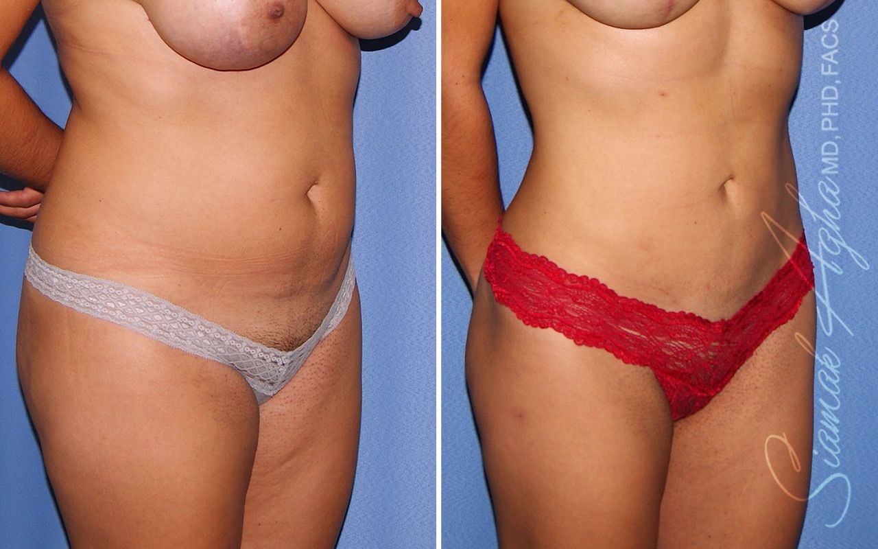 Liposuction Before & After