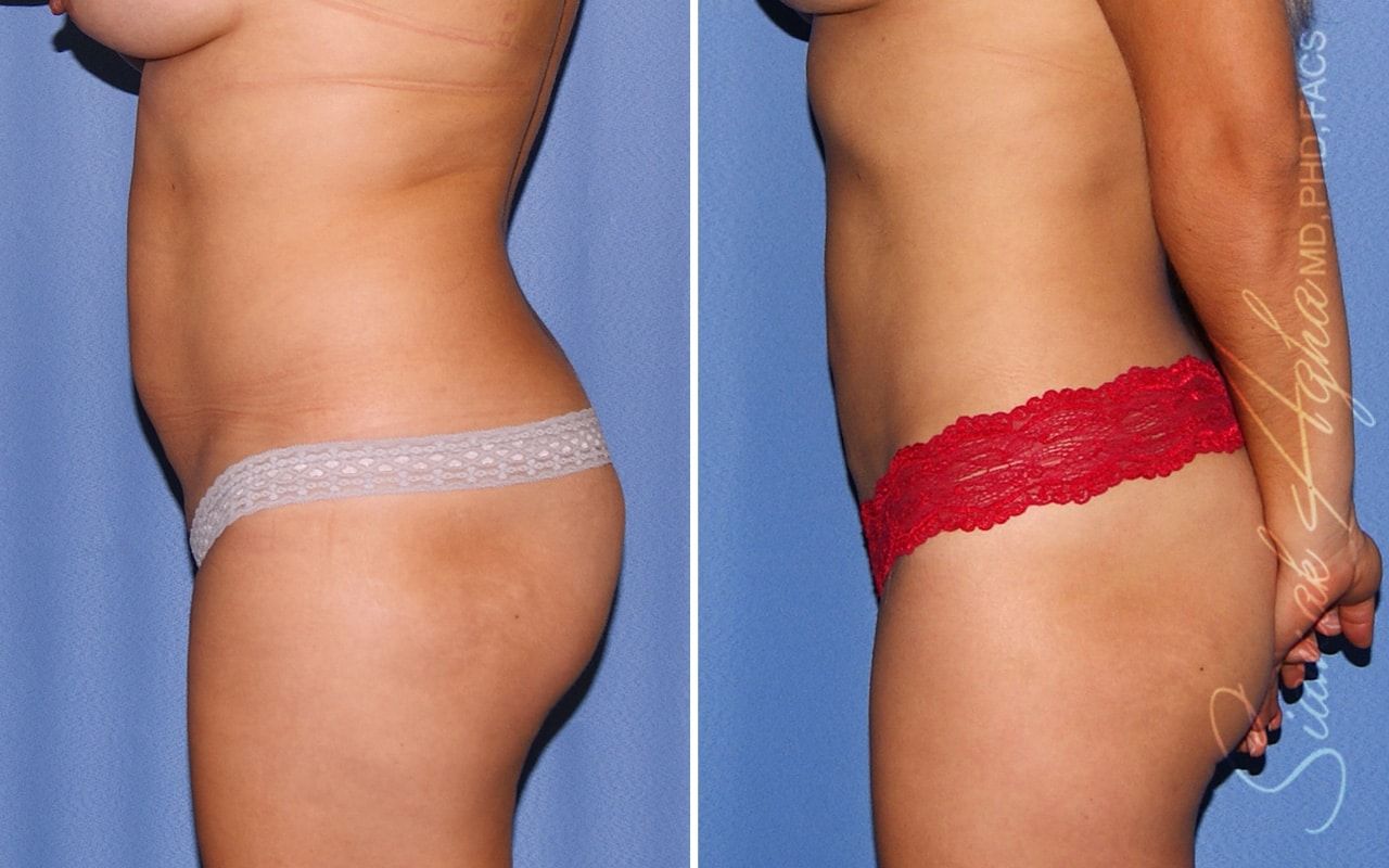 Liposuction Before & After