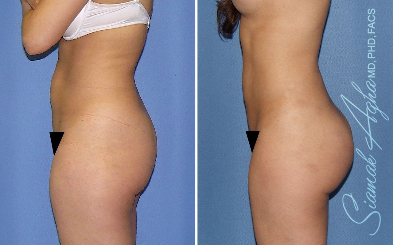 Liposuction Before & After