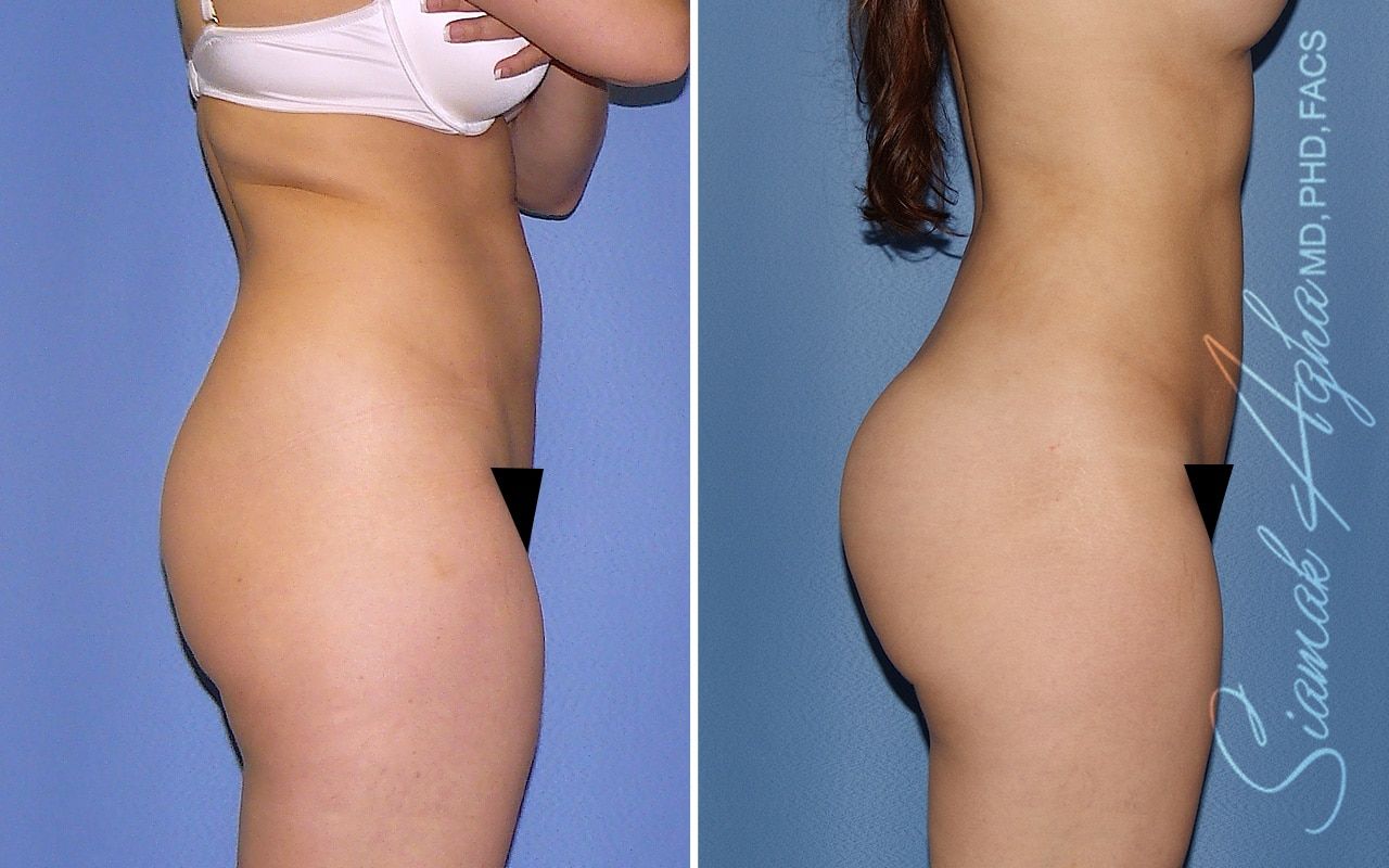 Liposuction Before & After