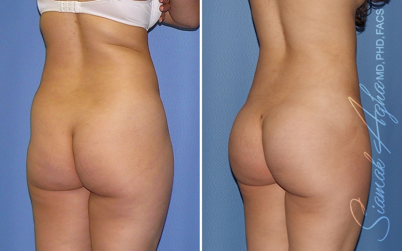 Liposuction Before & After