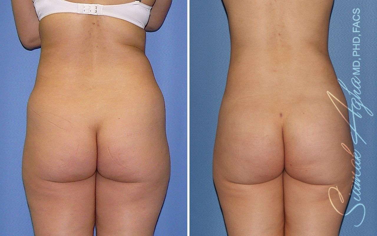 Liposuction Before & After