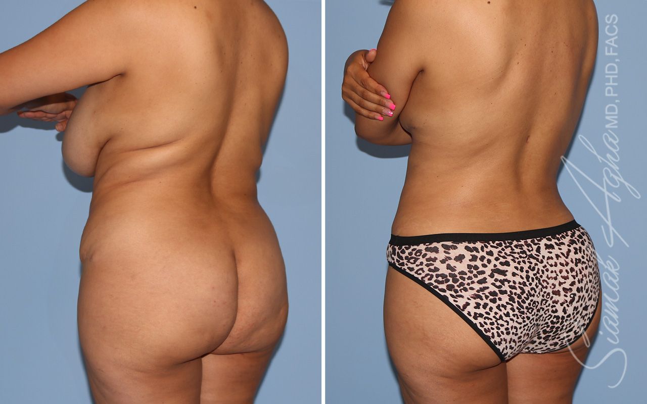 Liposuction Before & After