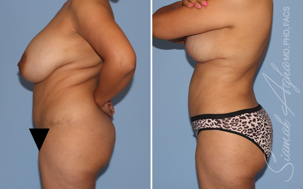 Liposuction Before & After