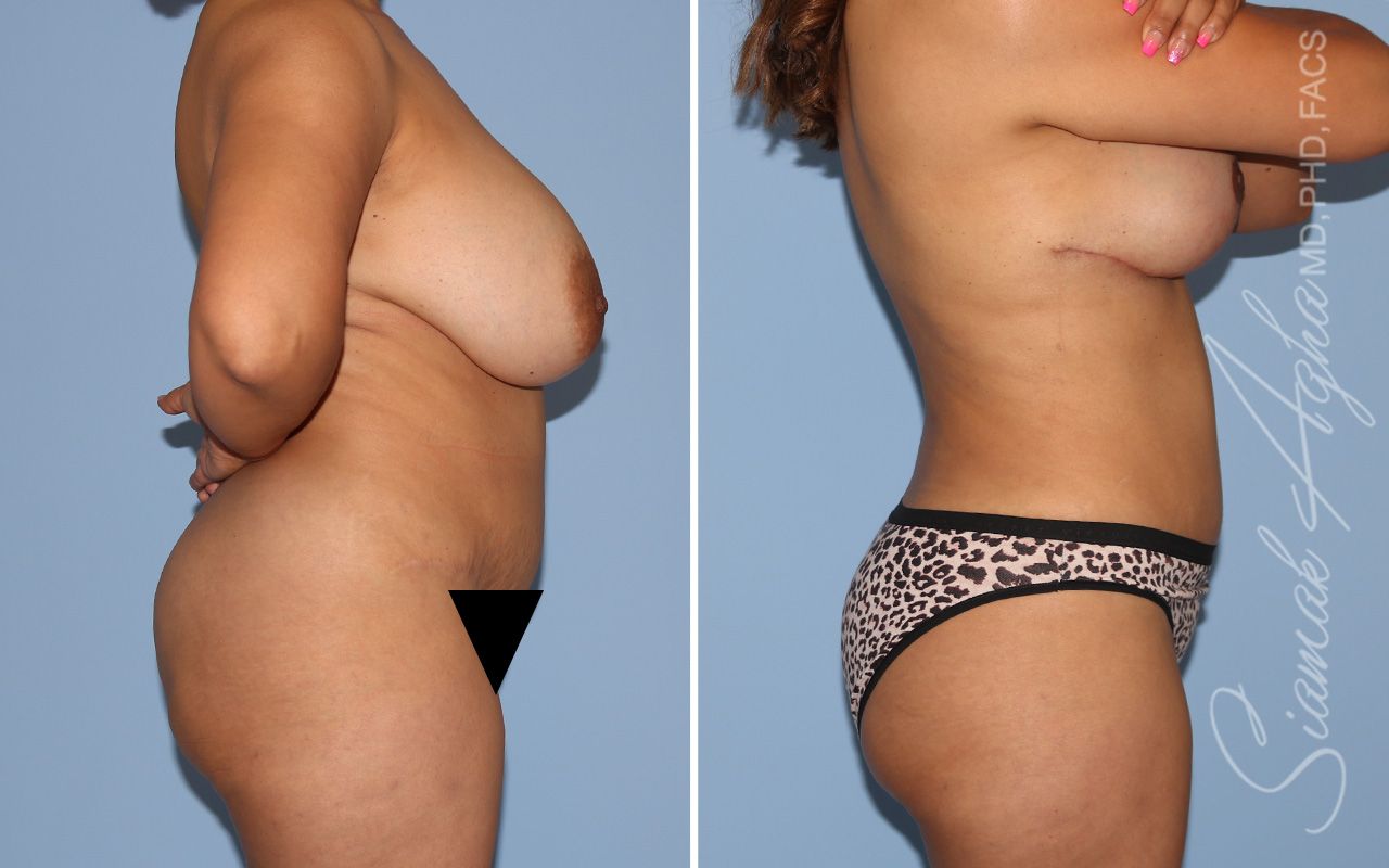 Liposuction Before & After