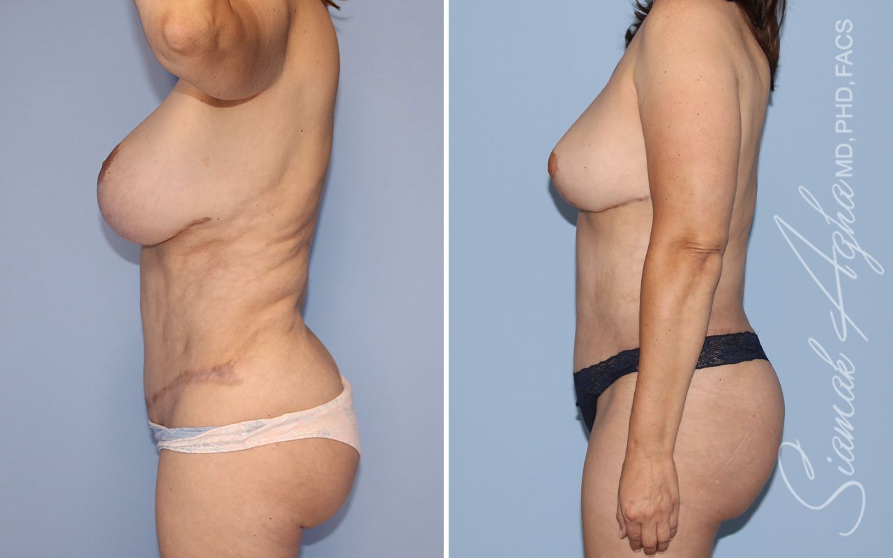 Liposuction Before & After