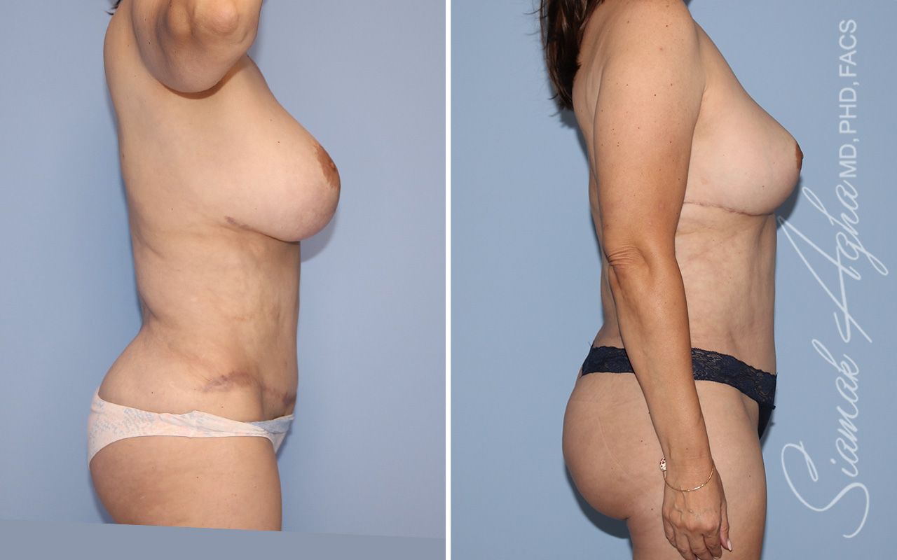 Liposuction Before & After