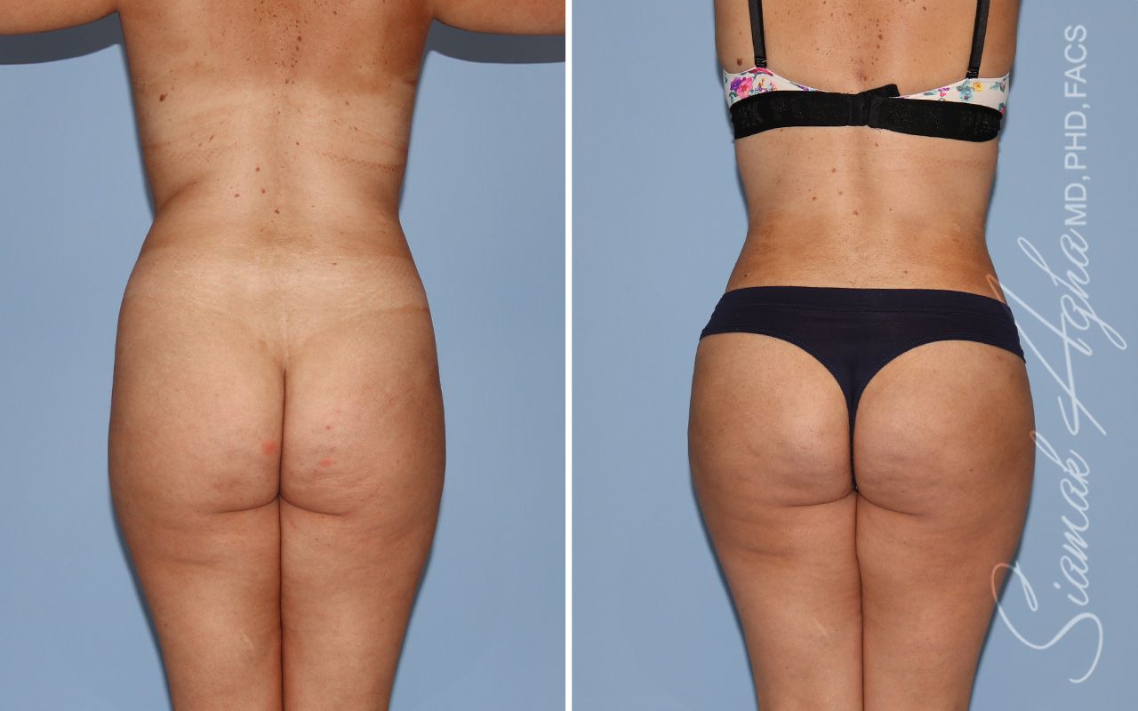 Liposuction Before & After