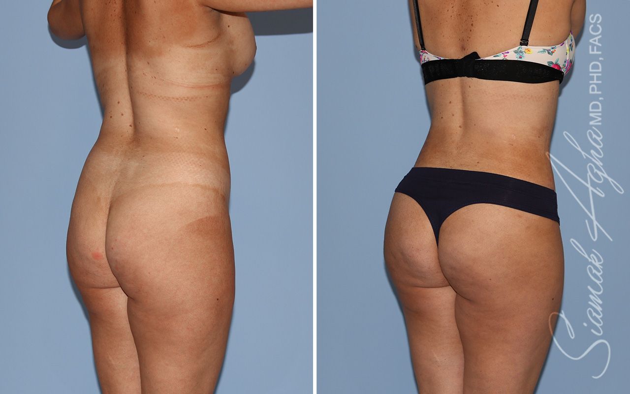 Liposuction Before & After