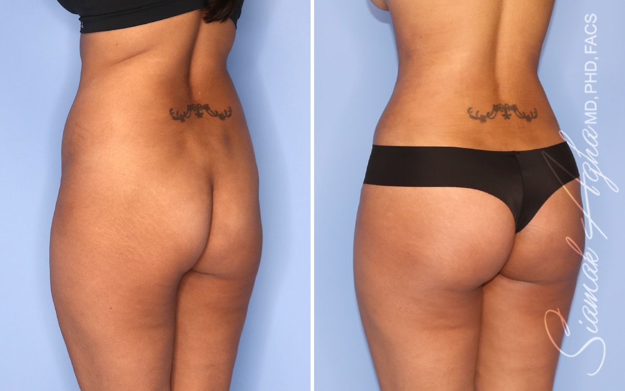Liposuction Before & After