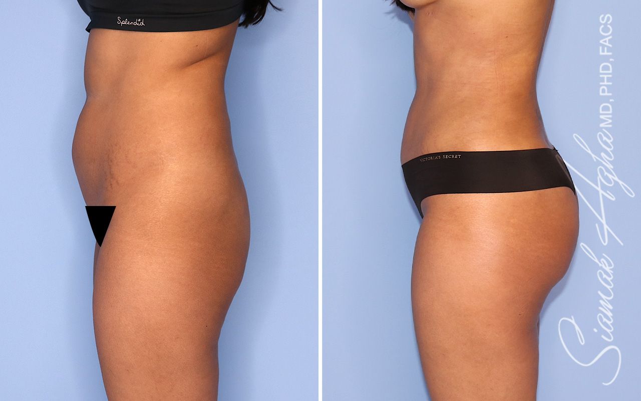 Liposuction Before & After