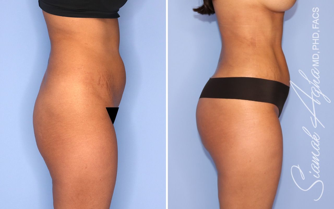 Liposuction Before & After