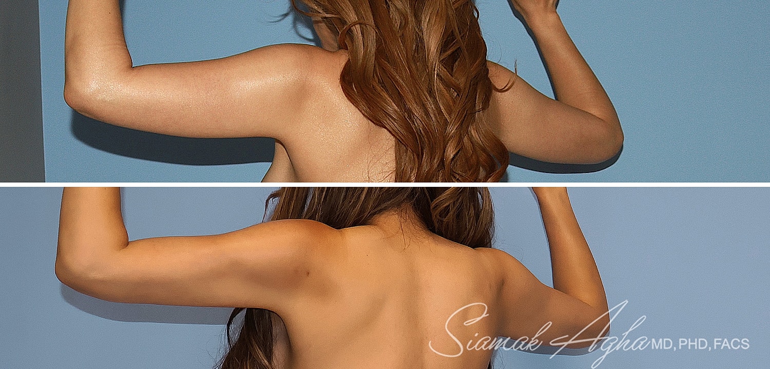 Liposuction Before & After