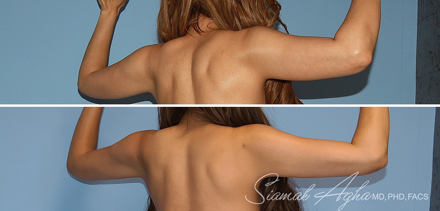 Liposuction Before & After