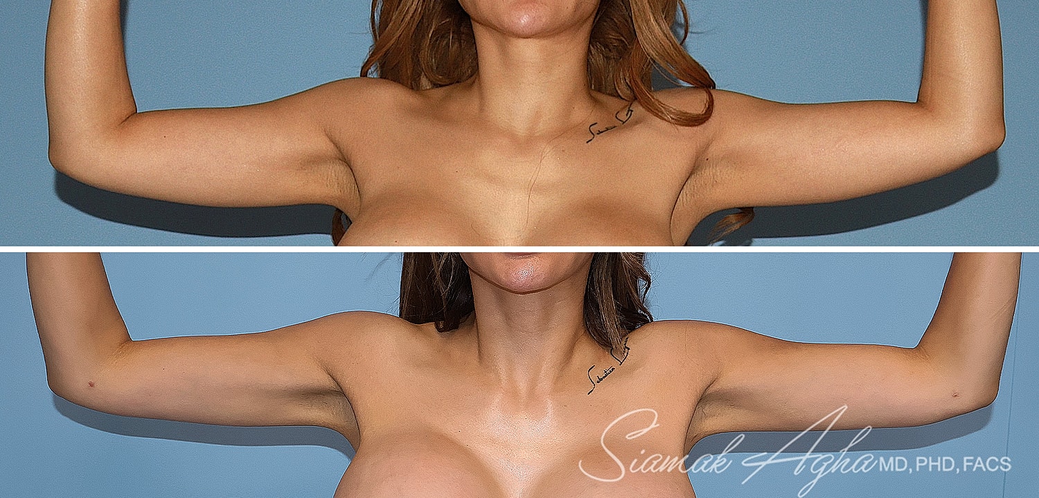 Liposuction Before & After