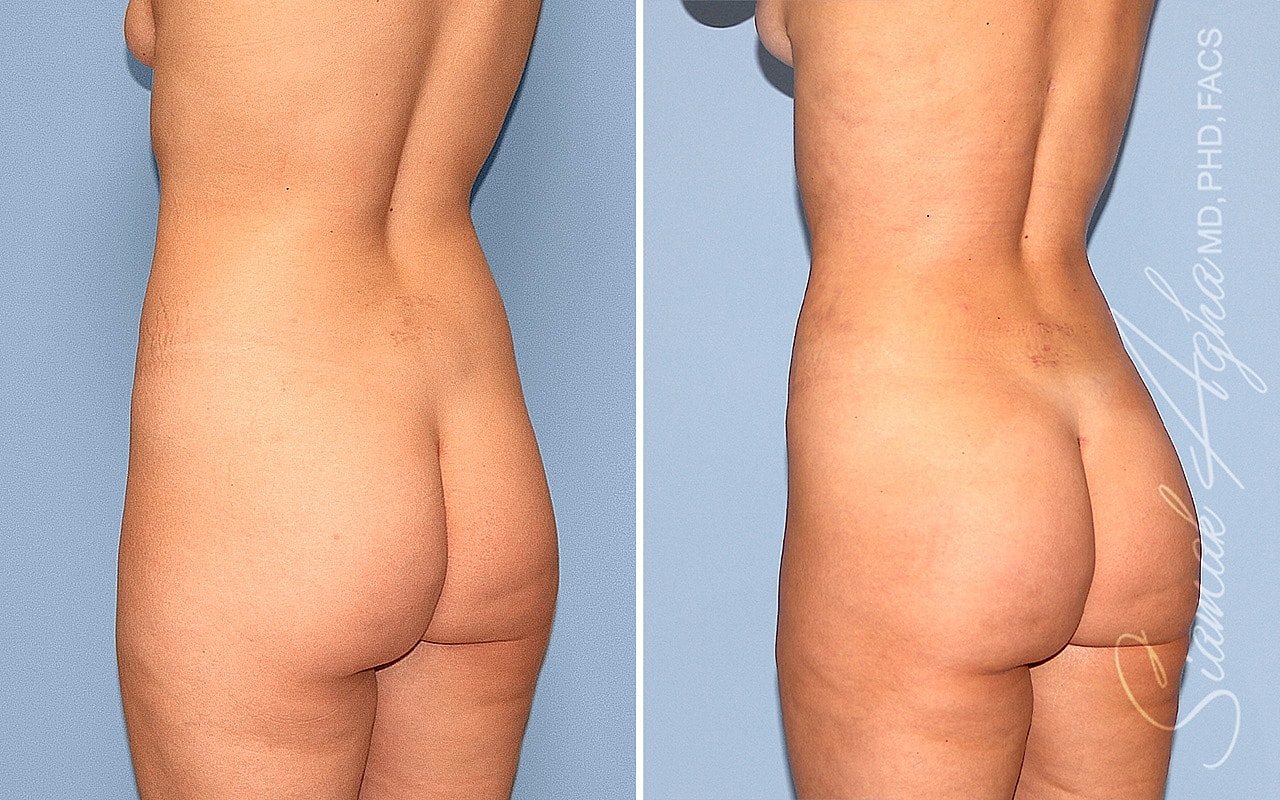 Liposuction Before & After