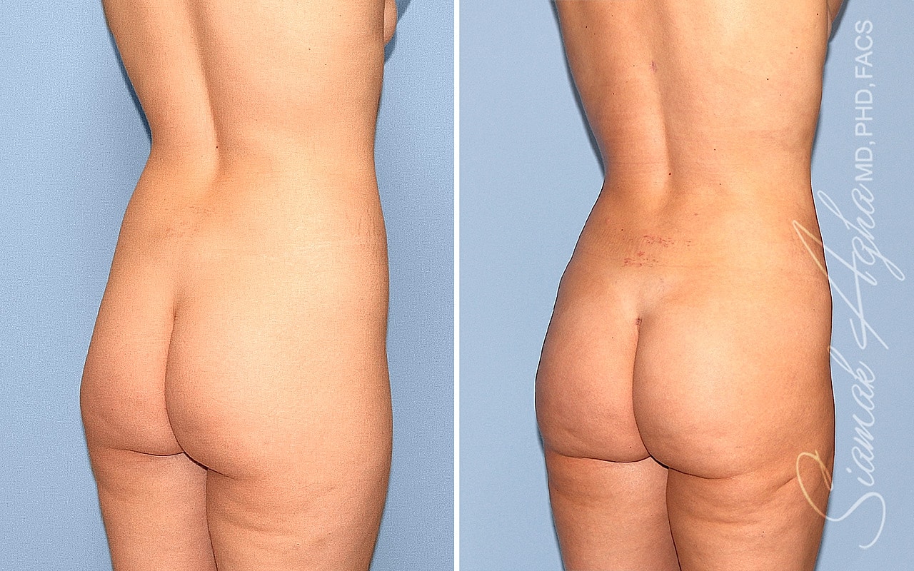 Liposuction Before & After