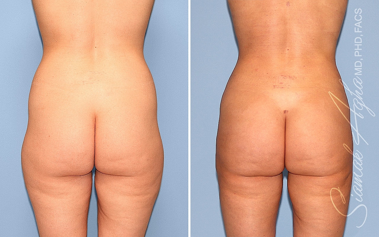 Liposuction Before & After